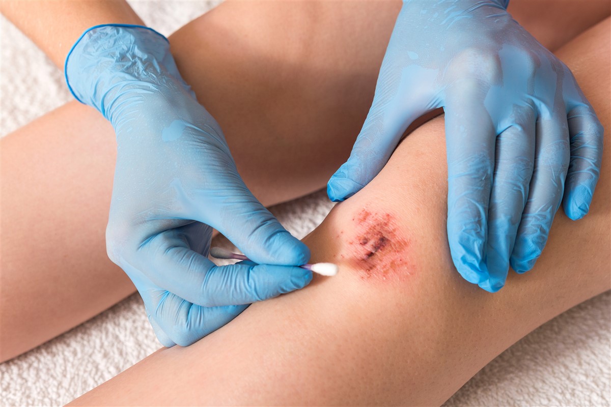 soigner les petites blessures